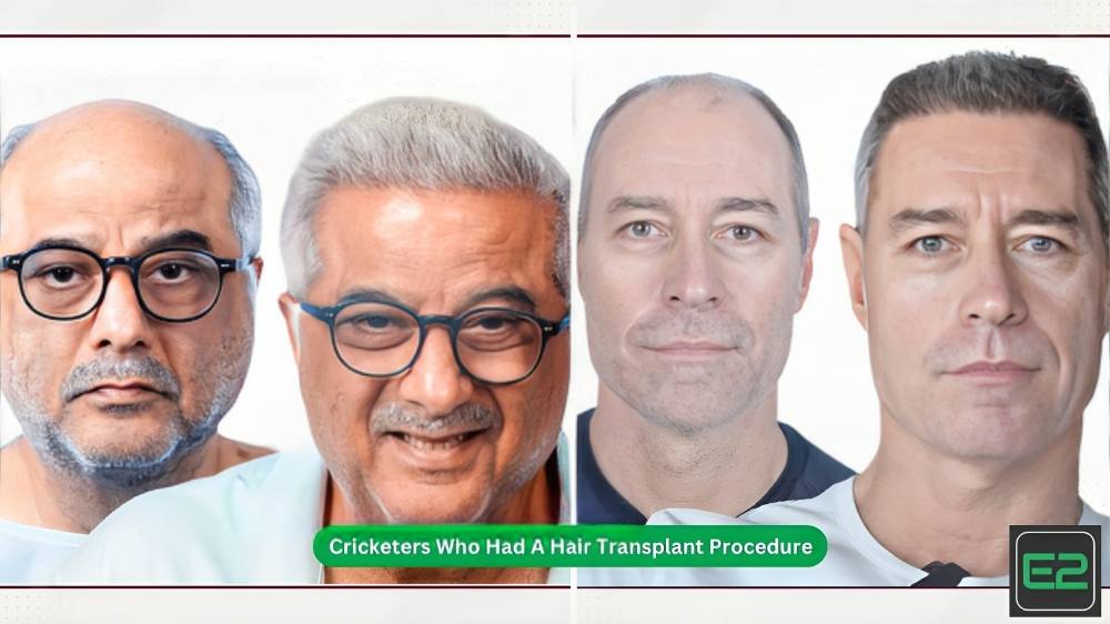 Cricketers Who Had A Hair Transplant Procedure