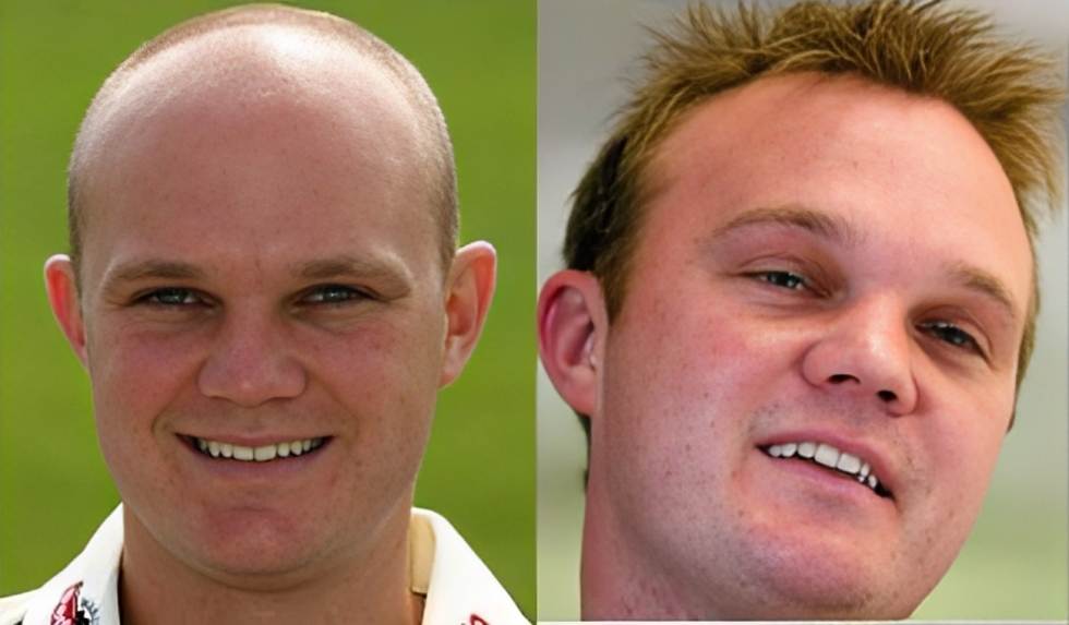 Doug Bollinger hair transplant