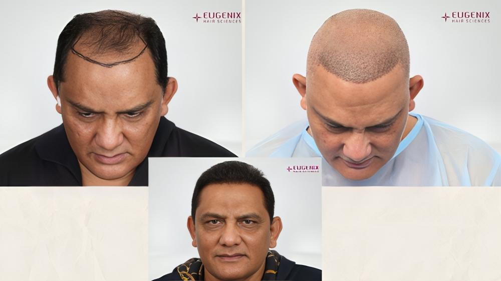 Mohammad Azharuddin hair transplant