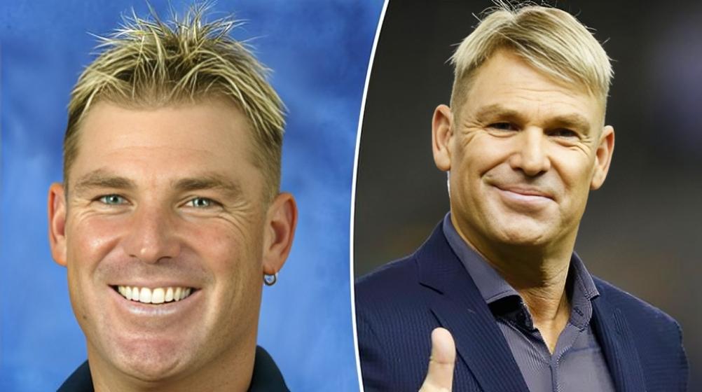 Shane Warne Hair Transplant