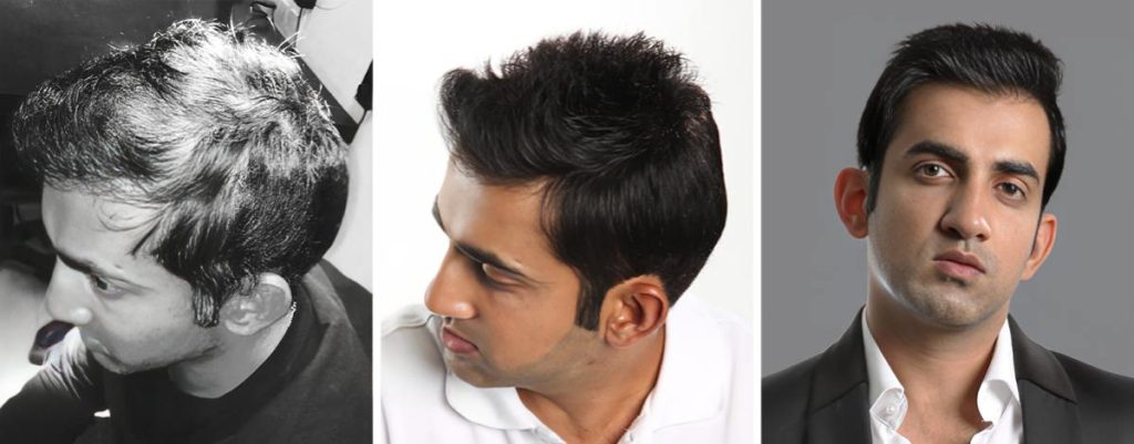 Gautam Gambhir Hair Transplant