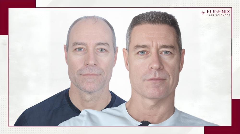 Michael Bevan hair transplant