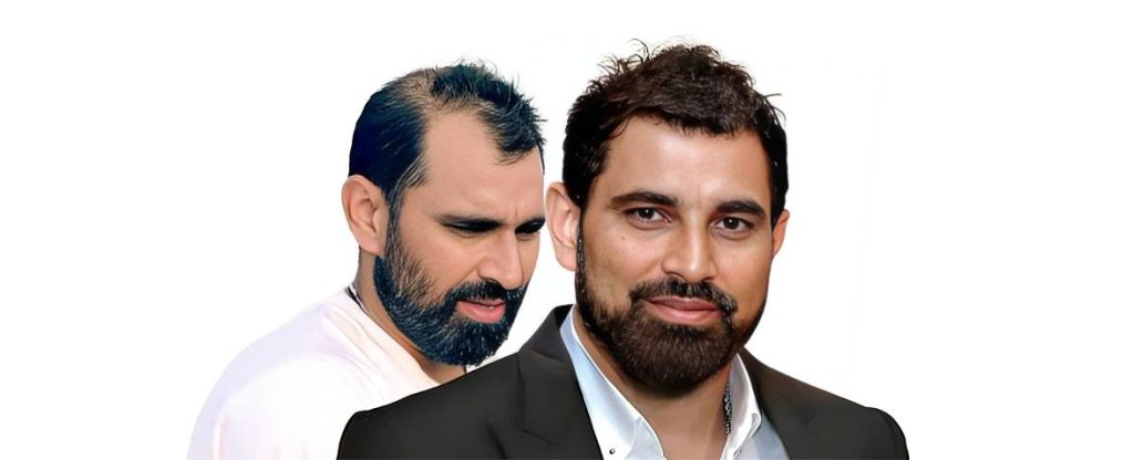 Mohammed Shami hair transplant