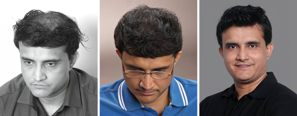 Sourav Ganguly hair transplant